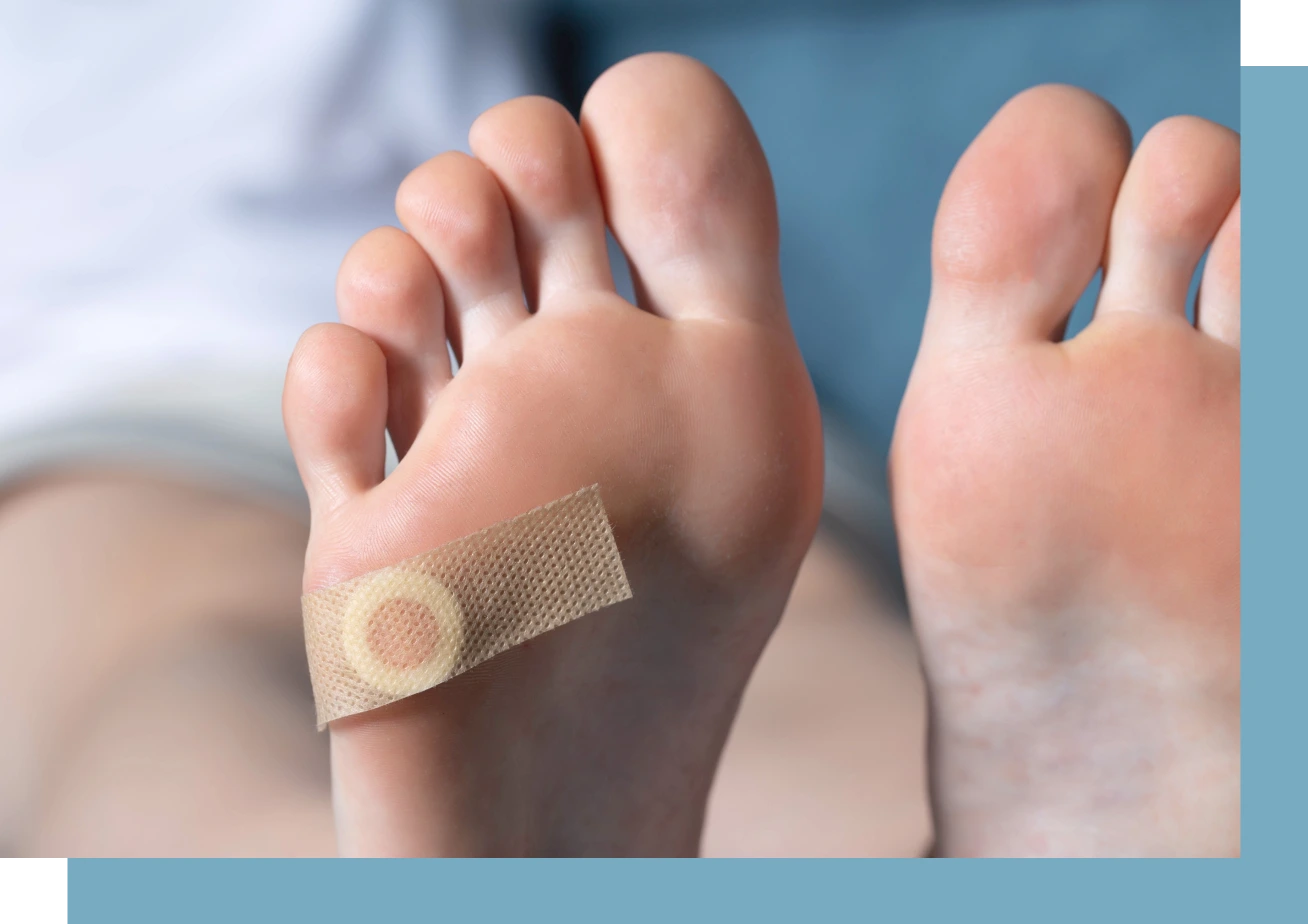 Plantar Warts Condition