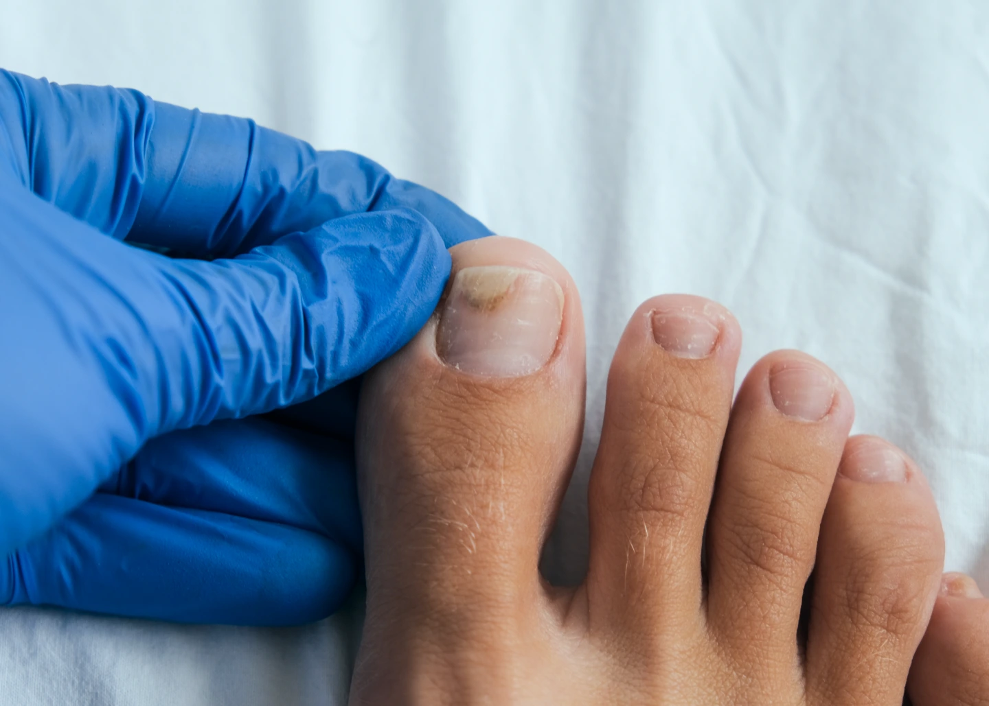 What Are Fungal Nails? Banner