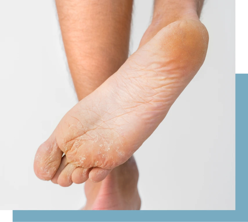 What Is Athlete’s Foot Treatment NYC Banner