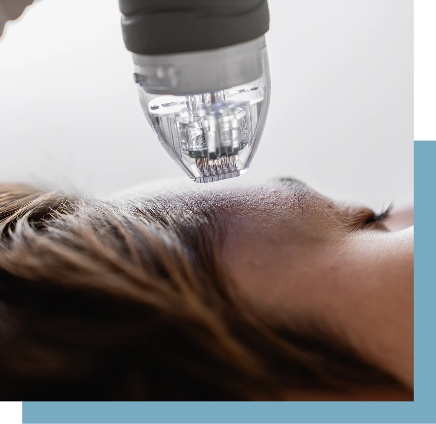 RF Microneedling in New York City Banner