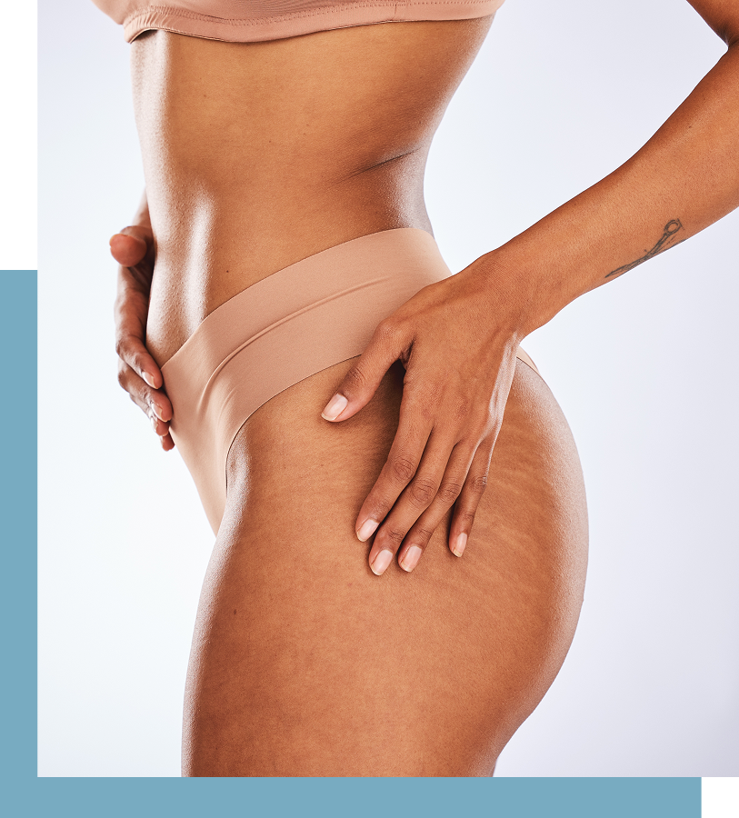 Stretch Mark Reduction in New York City Banner